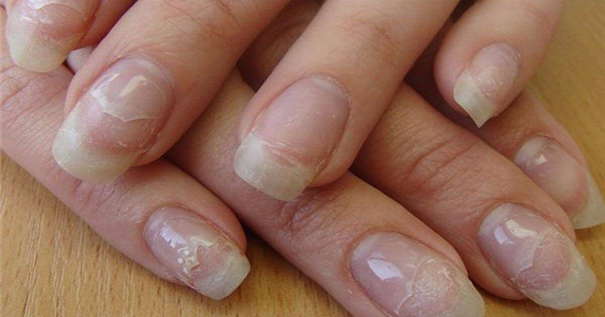 Почему слоятся ногти и что нужно сделать, чтобы их вылечить?