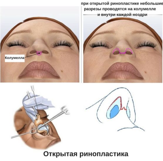 Ринопластика сегодня - виды, показания, этапы пластики носа и последствия
