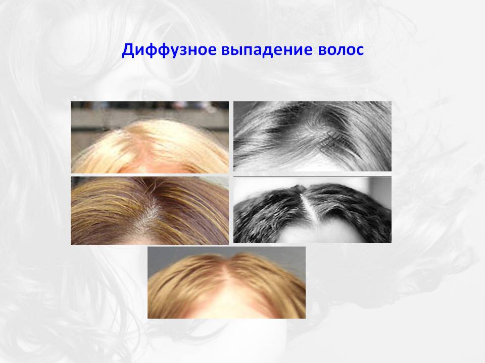 Причины диффузного выпадения волос у женщин, лечение