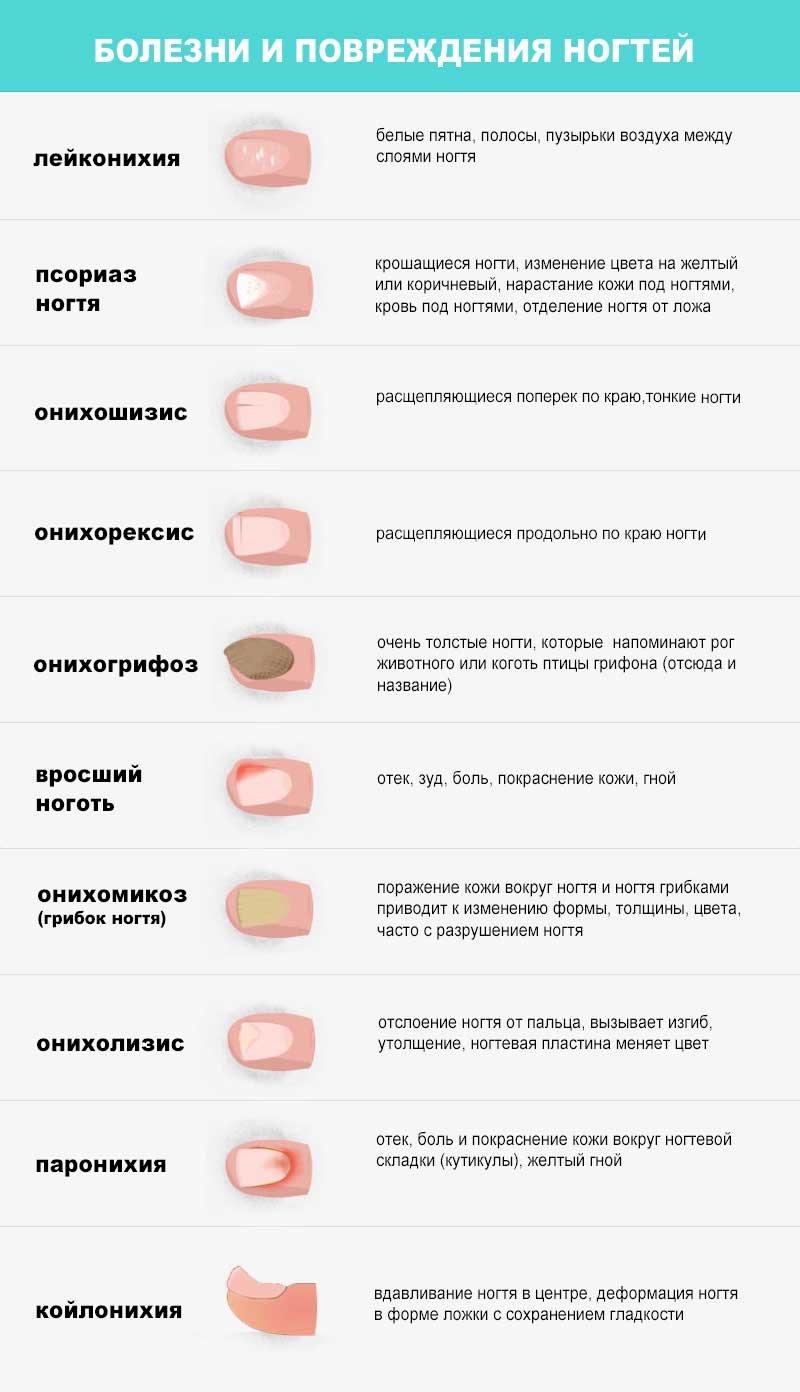 Болезни по ногтям: как определить состояние здоровья по внешнему виду ногтей | mfarma.ru