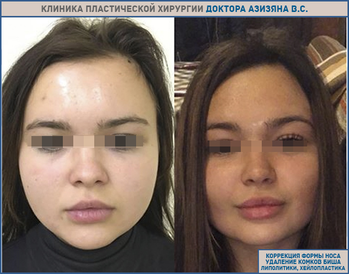 Комочки биша. удаление комков биша в майя клиник