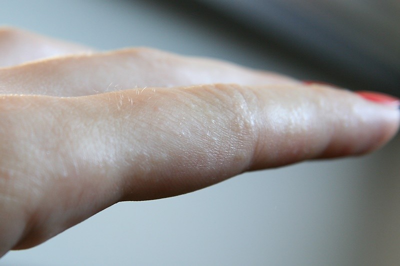 Почему шелушатся руки (ладони)  и ноги (стопы) -  патологические механизмы шелушения кожи