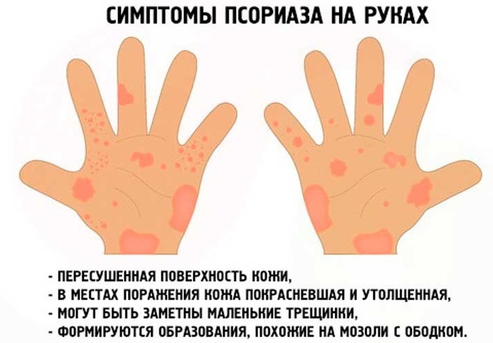 Почему трескаются и шелушатся подушечки пальцев рук: основные причины, лечение