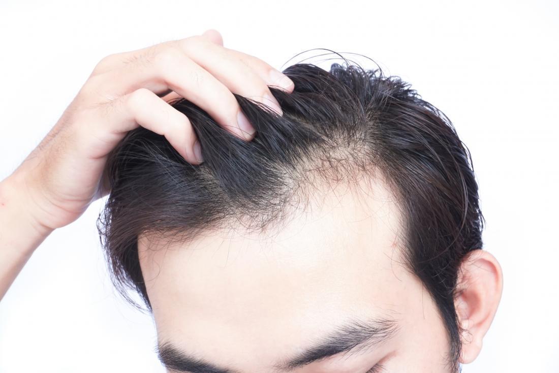 Причины выпадения волос у мужчин – публикации – лаборатория ан-тек