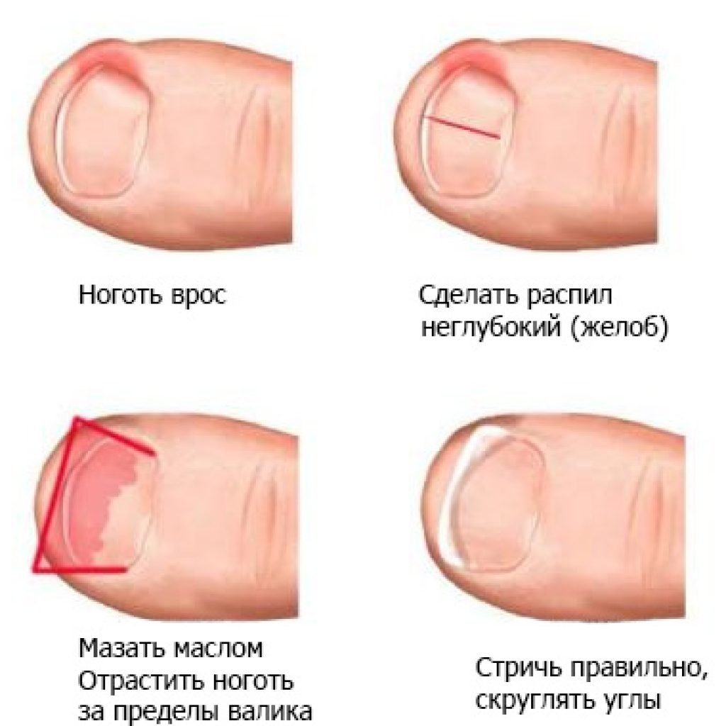 Мази для лечения вросшего ногтя