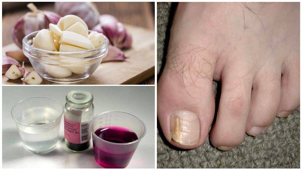 Чем лечить грибок ногтей на ногах и руках? средства для лечения запущенной формы заболевания: недорогие, но эффективные - medside.ru