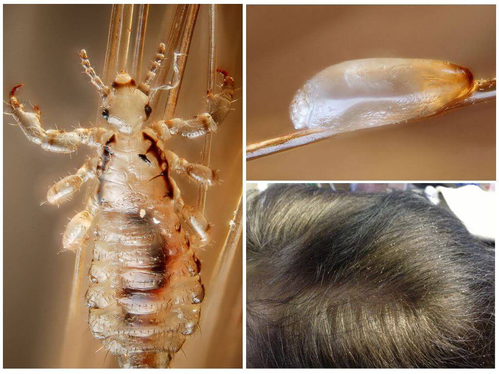 Как выглядят вши и гниды на голове у человека, на теле, под микроскопом на волосах, какого цвета бывают и их строение в зависимости от вида
