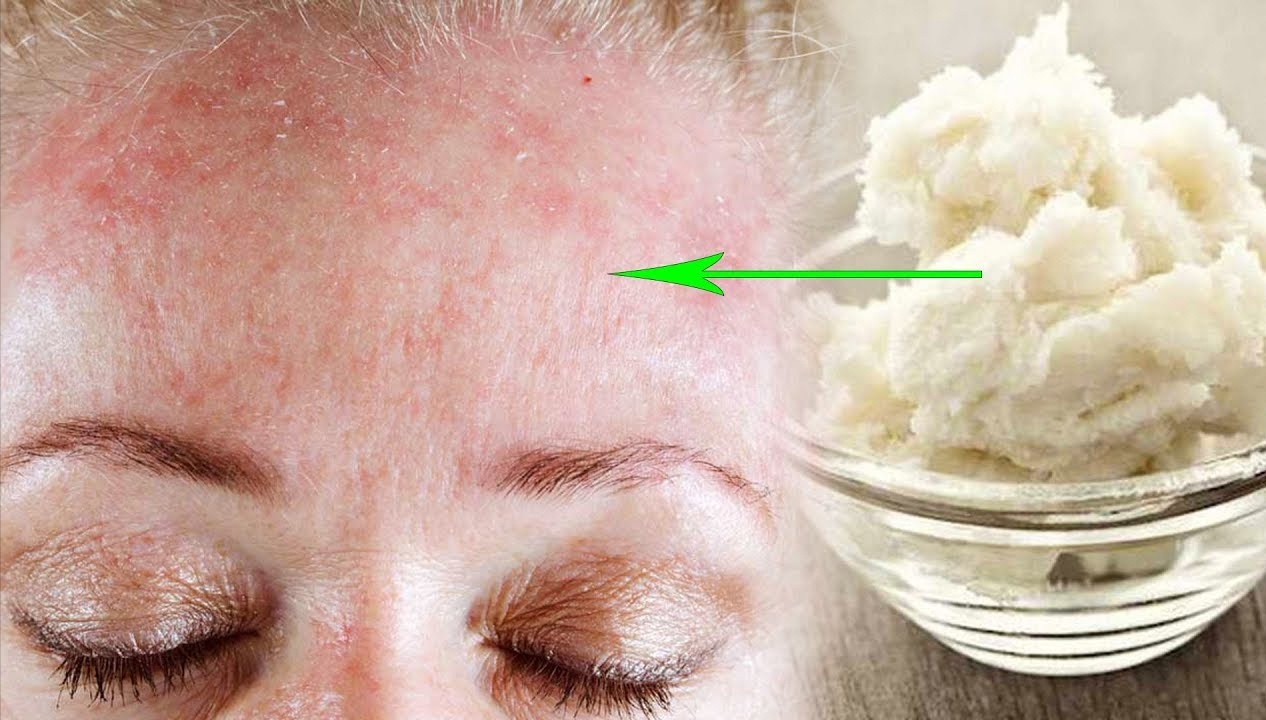 Шелушение кожи на лице – в чём причина?