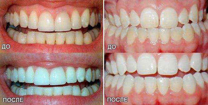 Отбеливание зубов перекисью водорода в домашних условиях: инструкция и отзывы