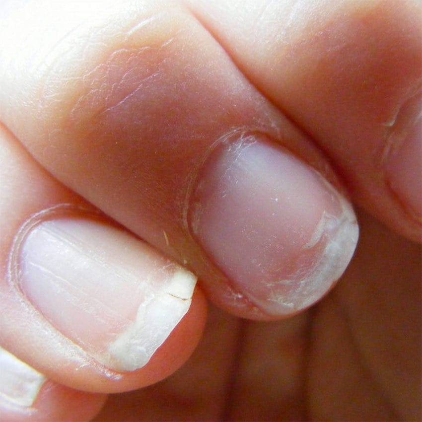 Слоятся ногти на руках - основные причины, советы и лечение