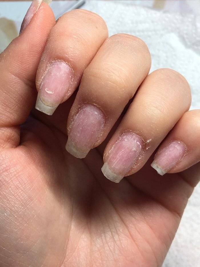 Как восстановить ногти после наращивания: 8 советов 
