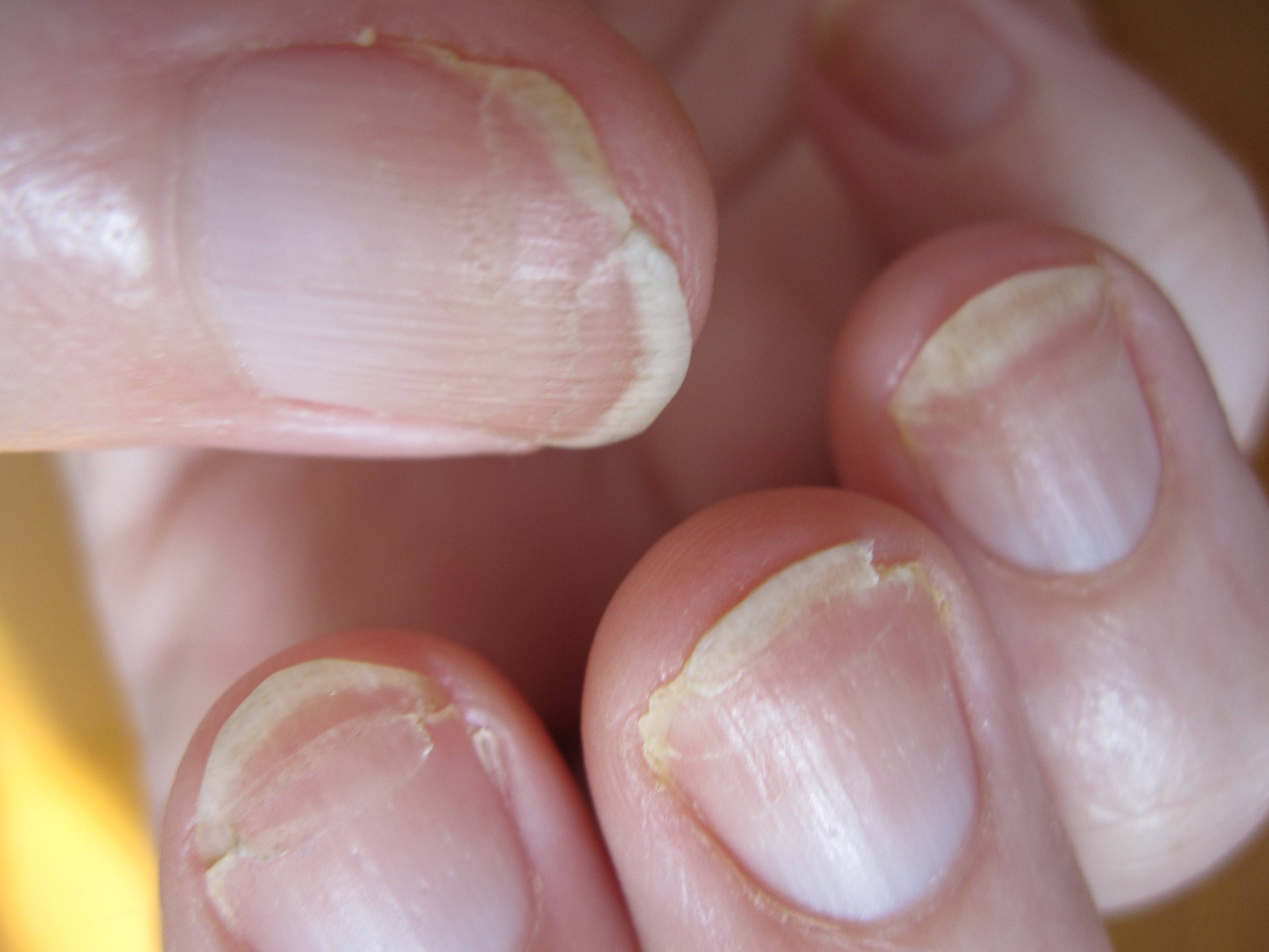 Ногти отслаиваются от ногтевого