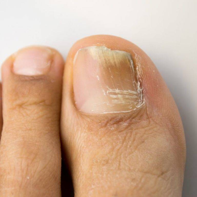 Грибок ногтей на ногах (онихомикоз): признаки и симптомы. фото