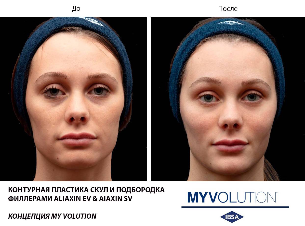 Контурная пластика лица гиалуроновой кислотой, фото до и после, стоимость.