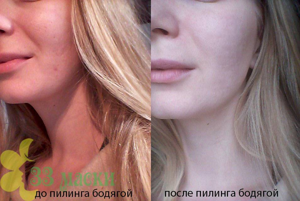Пилинг бодягой в домашних условиях избавляет от прыщей