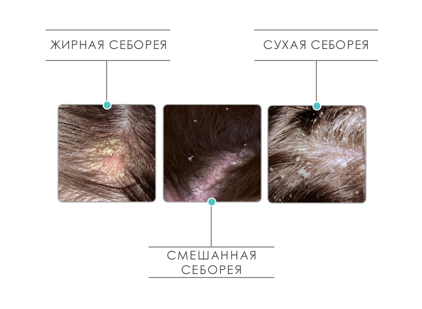 Себорейный дерматит: причины, диагностика, лечение | портал 1nep.ru