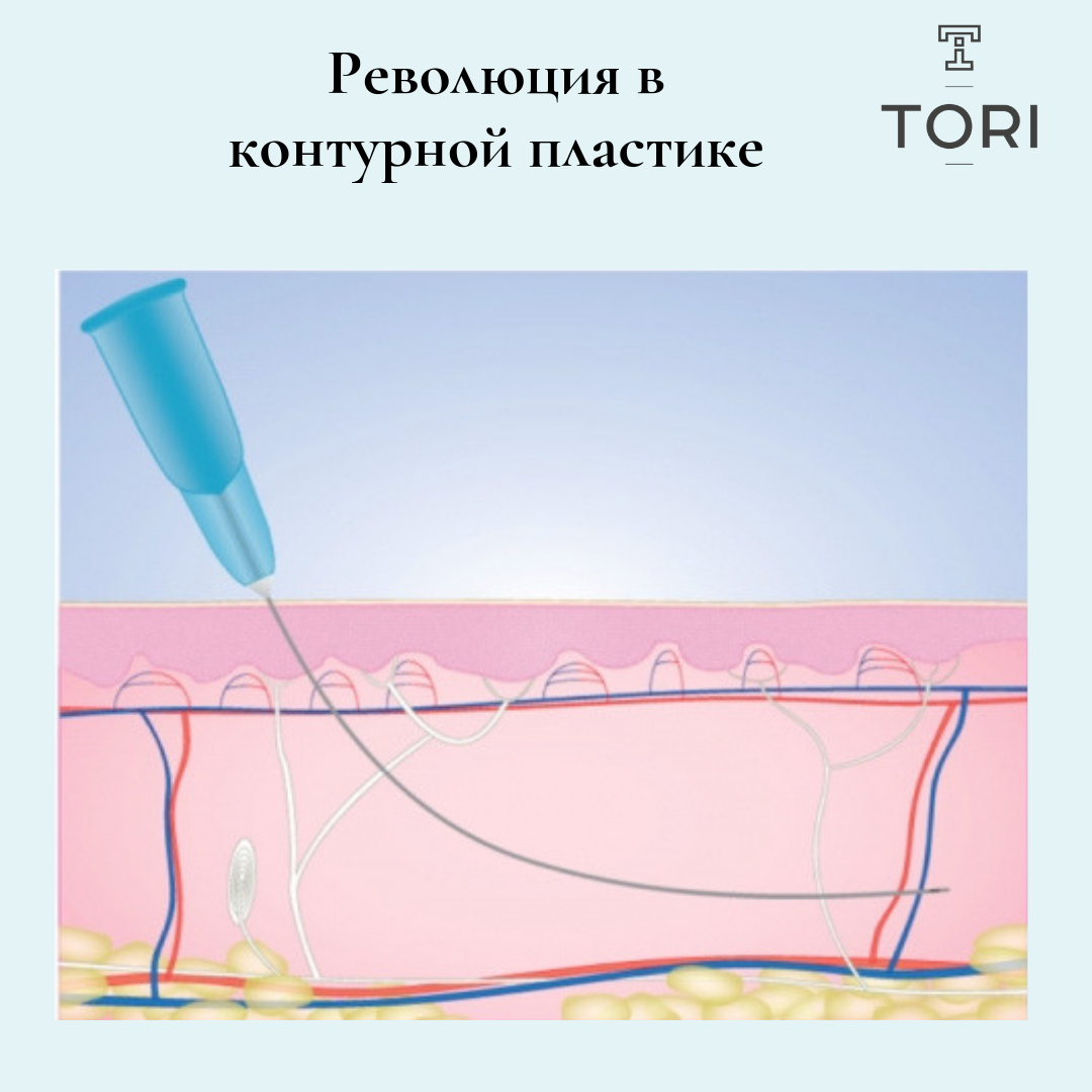 Канюля для контурной пластики в косметологии: отзывы