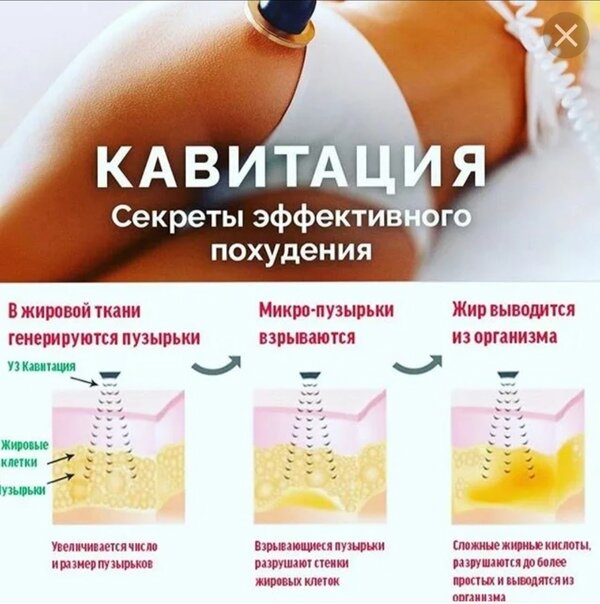 Секреты успешной кавитации или безоперационной липосакции