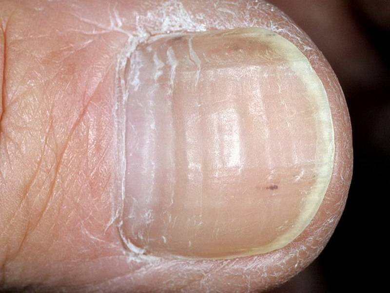 Лечение дистрофии ногтей