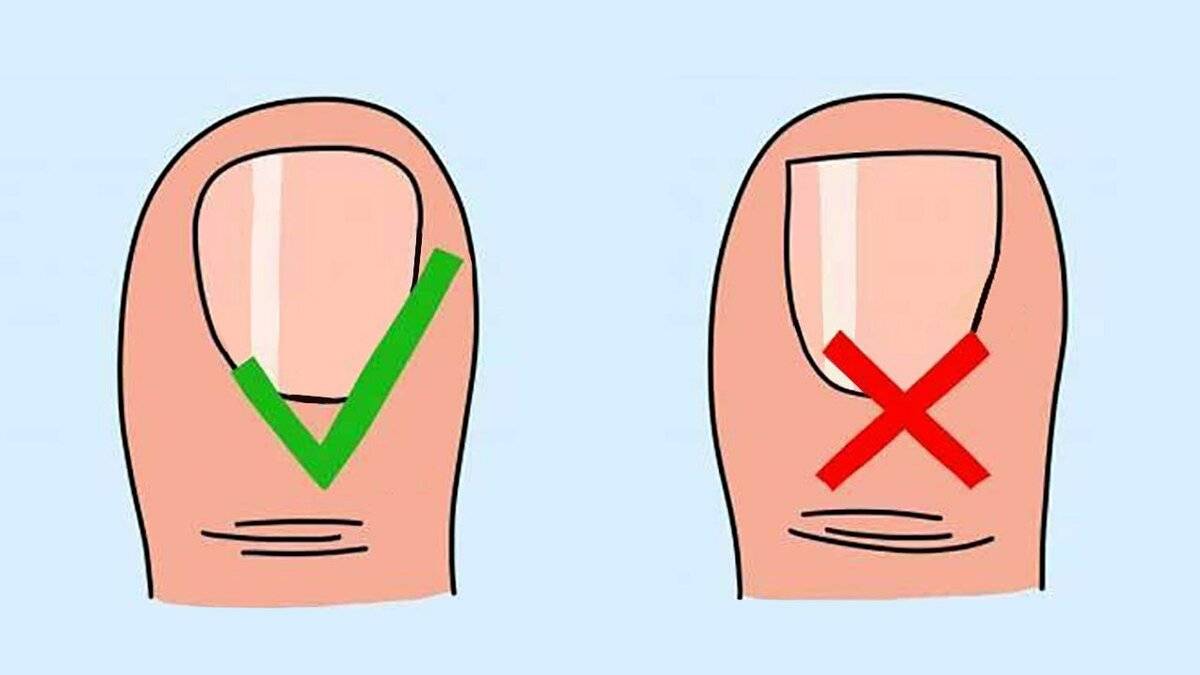 Как правильно подстричь ногти на ногах чтобы они не врастали