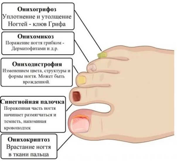 Заболевания ногтей и кожи для мастера ногтевого сервиса (с фото)