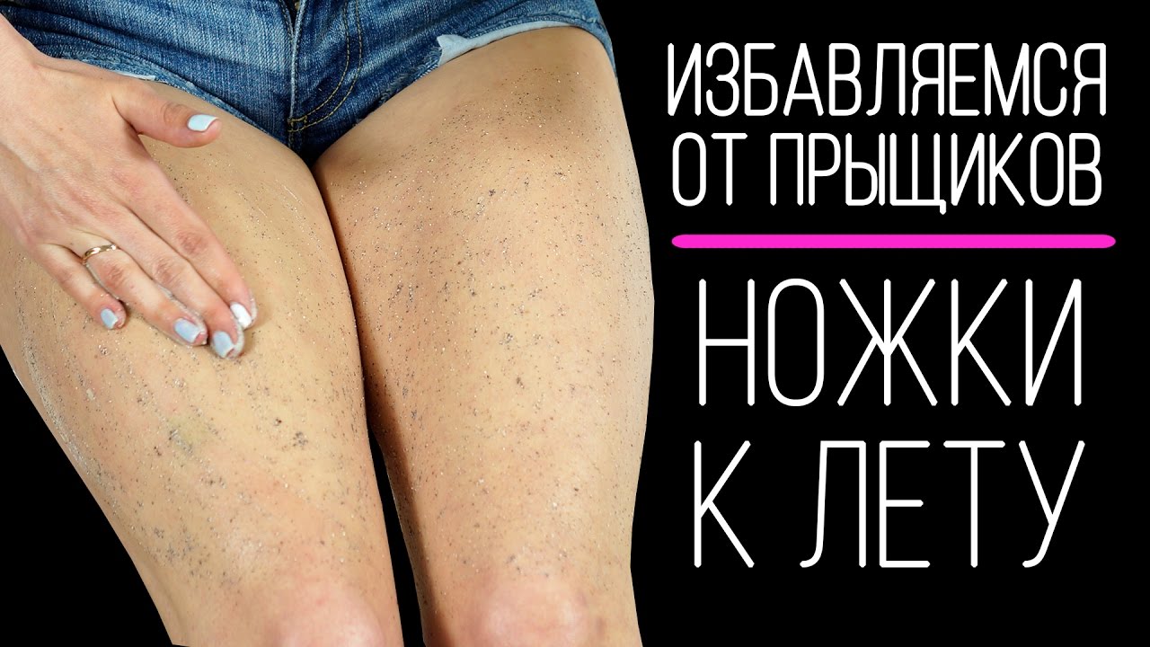 Как убрать прыщи на попе в домашних условиях