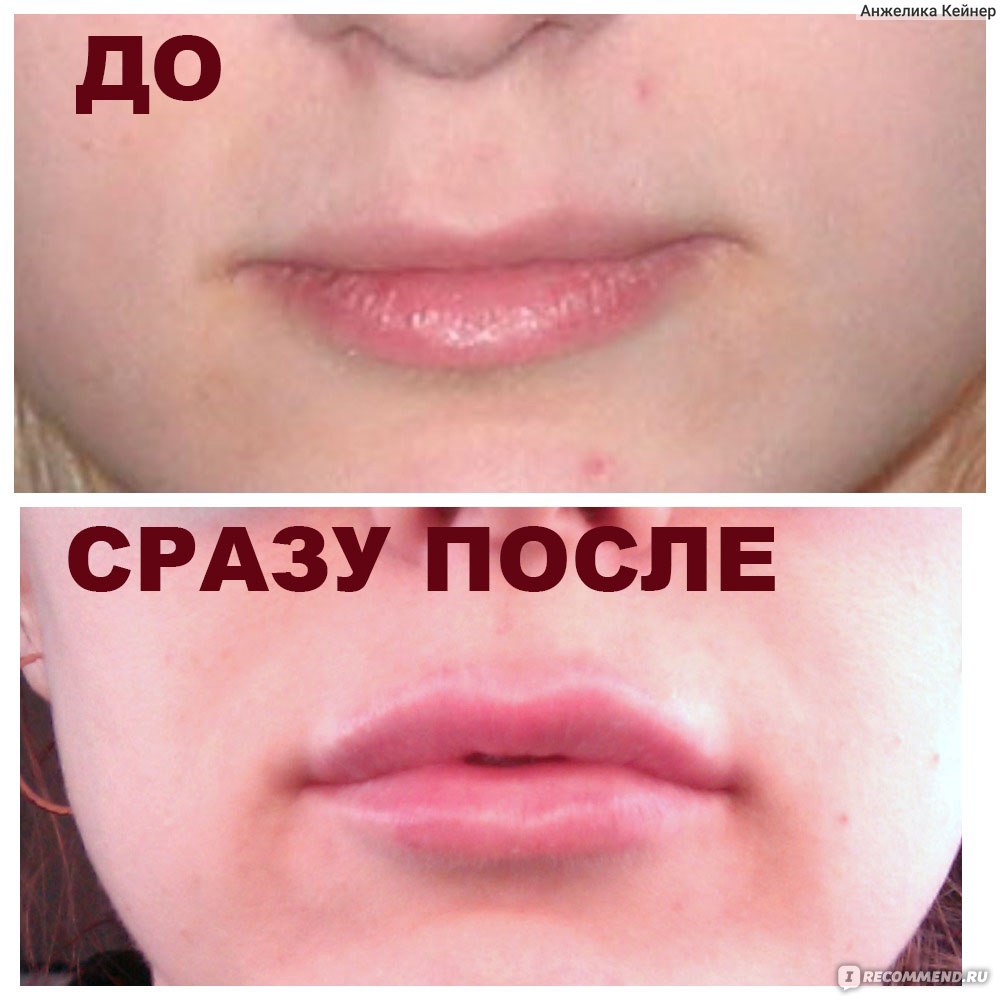 Увеличения губ гиалуроновой кислотой, что нельзя делать после процедуры - косметология доктора корчагиной