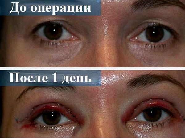 Блефаропластика (пластика век)