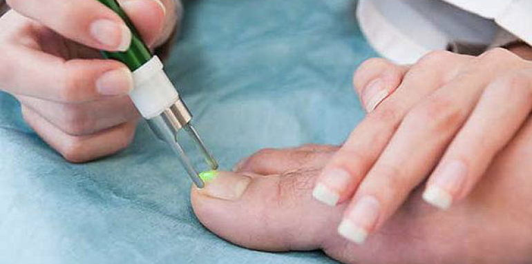Лечение грибка ногтей на руках лазером
