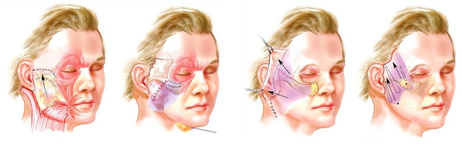 Эндоскопическая подтяжка лица - пластический хирург кудинова