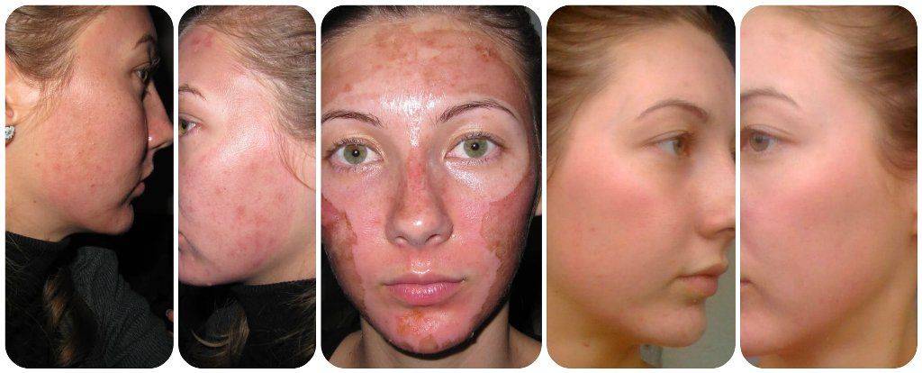 Уход за кожей после пилинга лица. советы, рекомендации, особенности