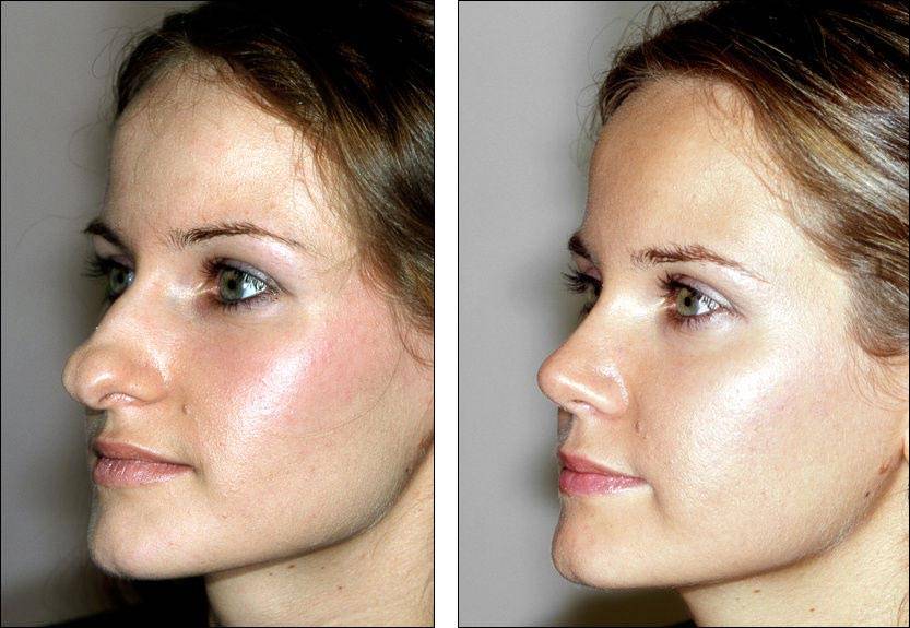 Ринопластика длинного носа - фото до и после