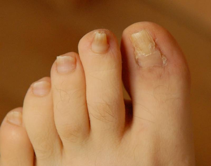 Утолщенные ногти на ногах: лечение и профилактика