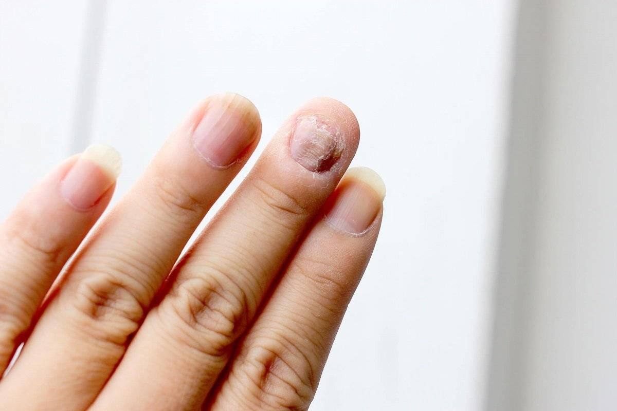 Грибок под ногтями на руках: как его вылечить?