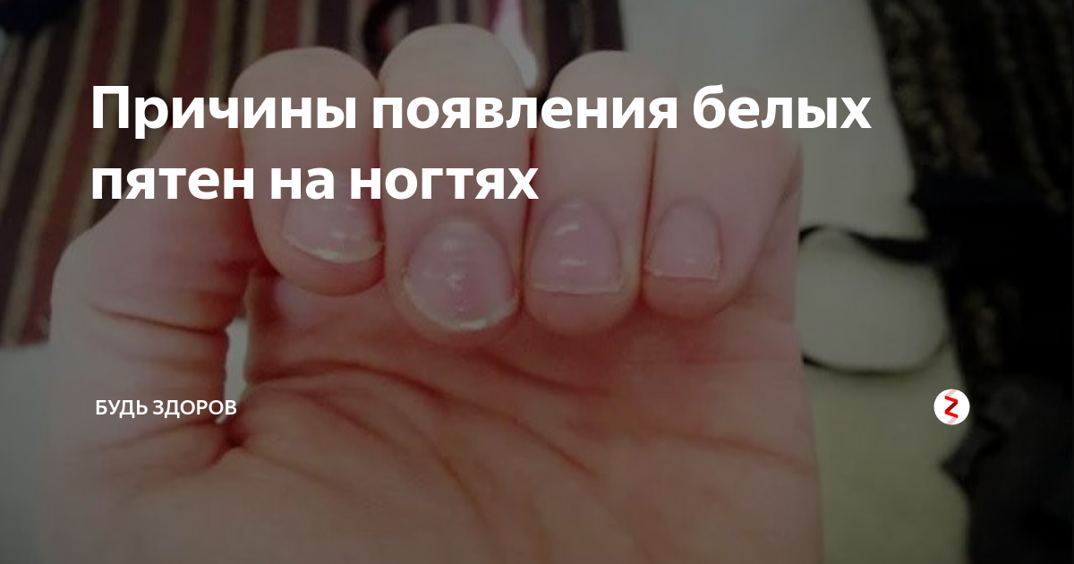 Белые пятна на ногтях. почему это опасно?