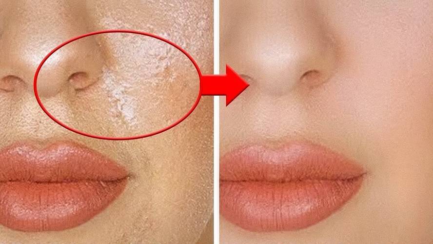 Как избавиться от жирного блеска на лице в домашних условиях