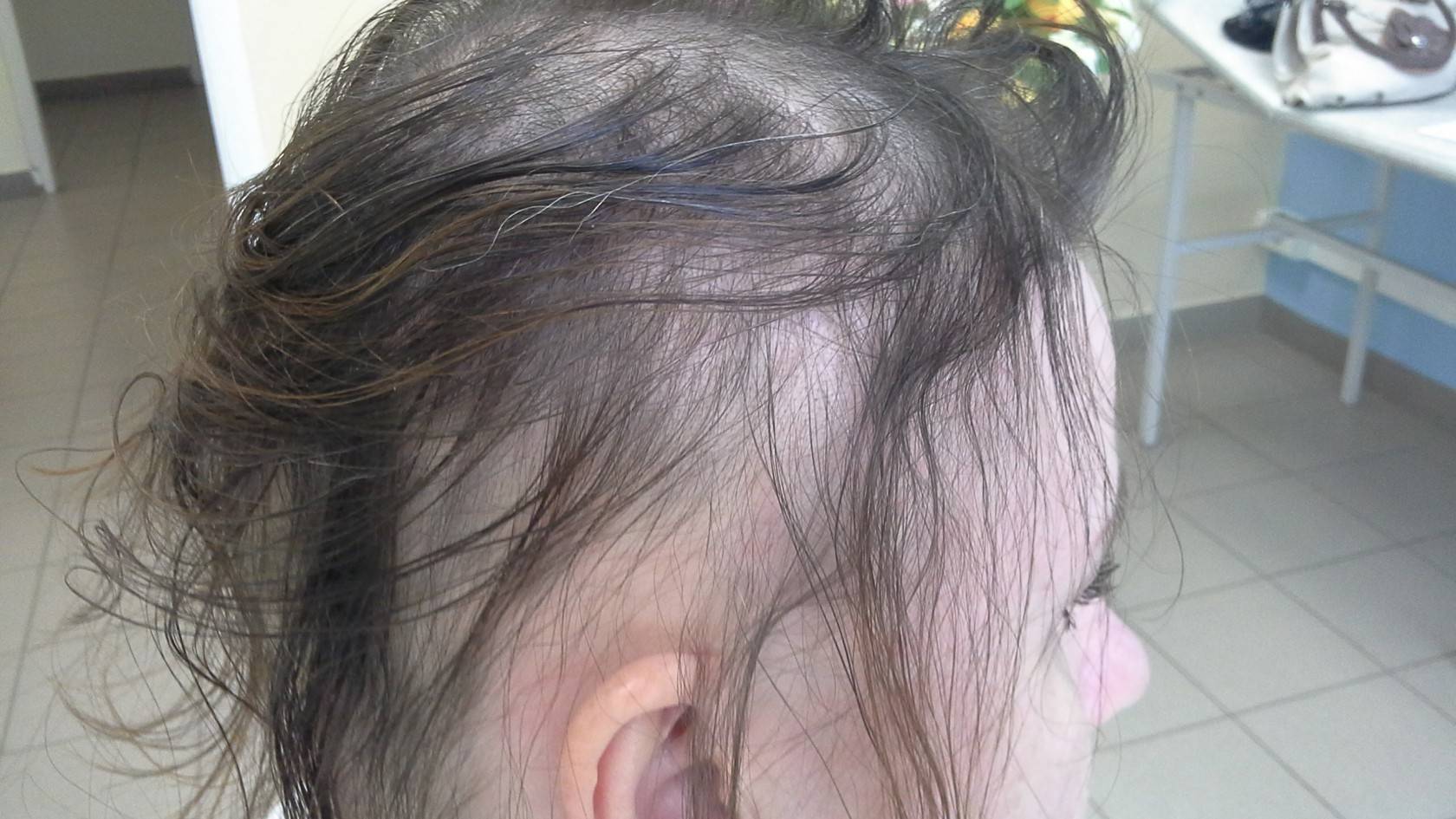Алопеция (выпадение волос) лечение в краснодаре