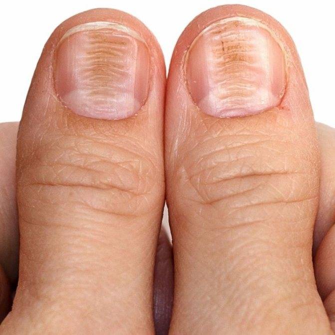 Проблемы ногтей у пожилых