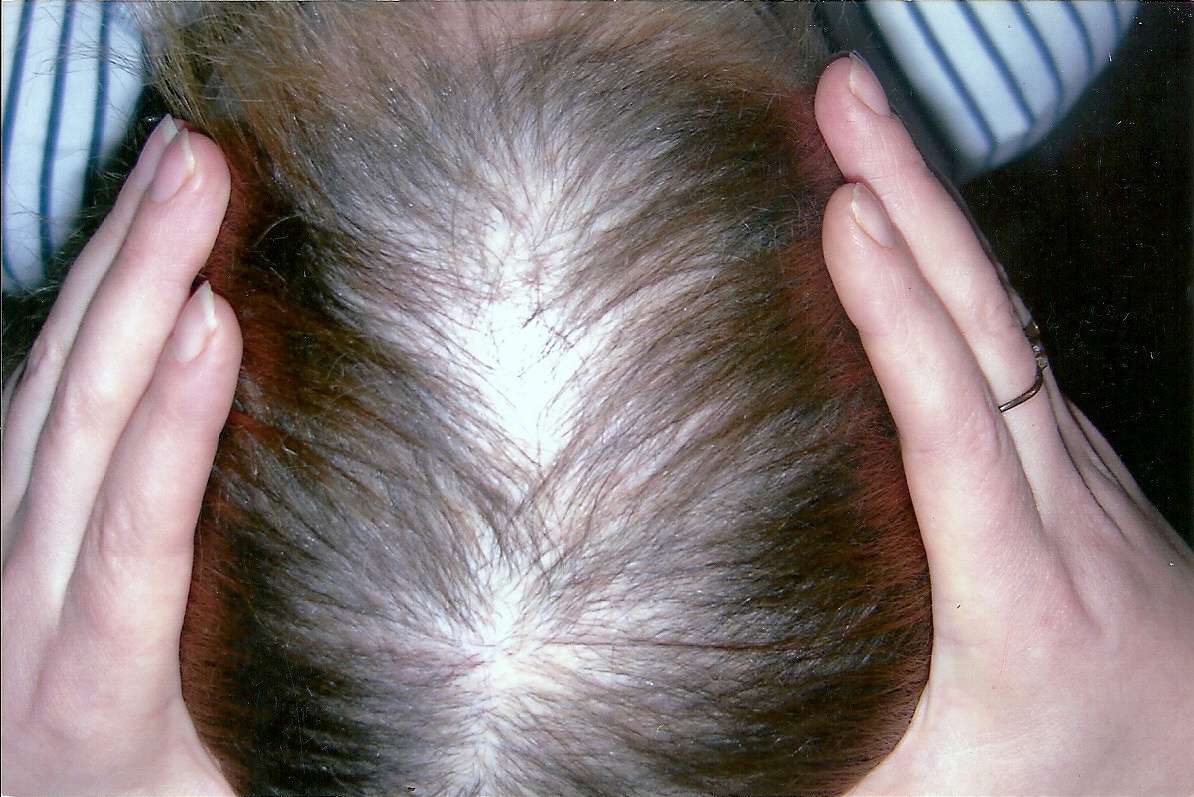Что такое диффузное выпадение волос у мужчин