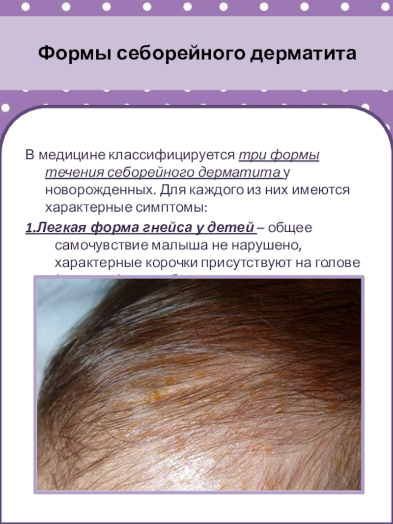 Себорея кожи головы у взрослых и детей: причины и лечение 
 | клиника меди лайф