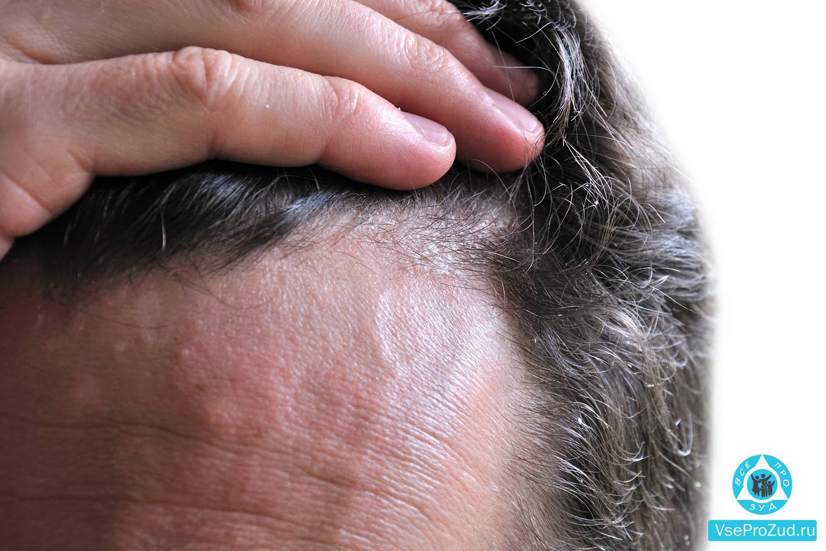 Псориаз на голове - как лечить, причины и симптомы заболевания