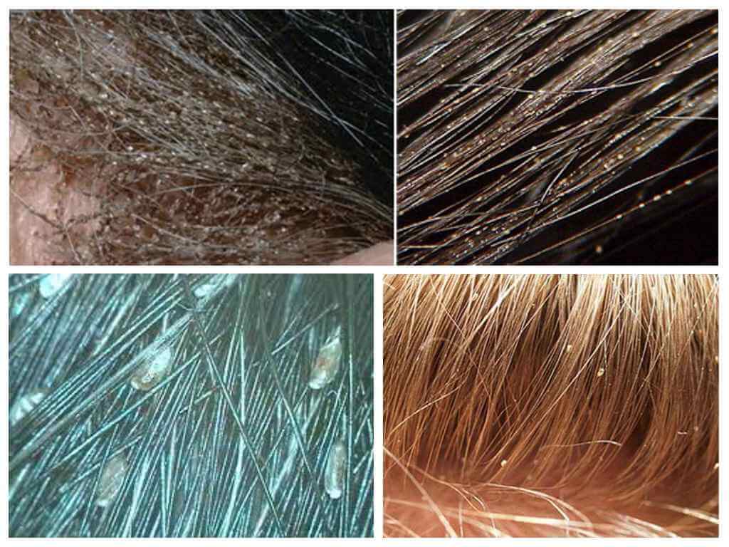 Чем вывести вшей и гнид с длинных волос у ребенка и взрослого в домашних условиях быстро и эффективно