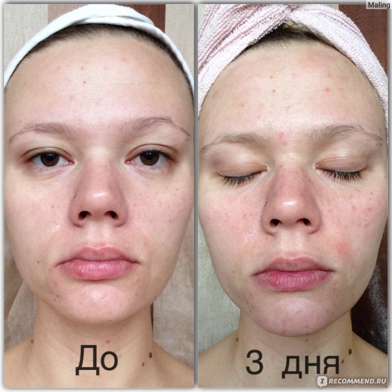 Уход за кожей после пилинга. - sunnyface