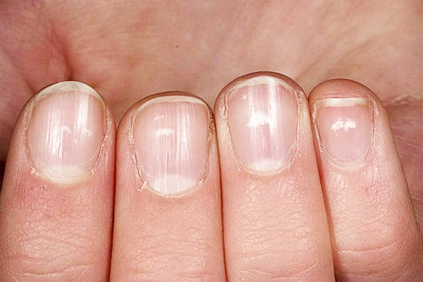 Белые полоски на ногтях– почему появляется лейконихия и как с ней бороться