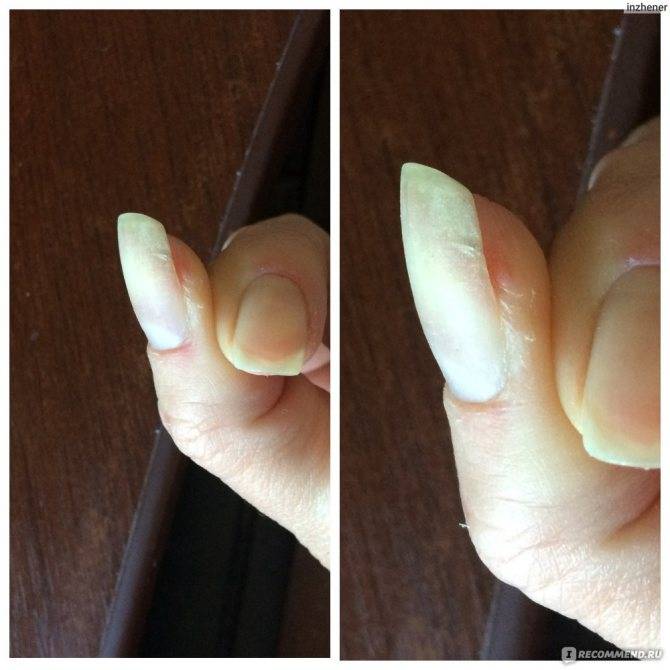 Что делать при травме ногтя?