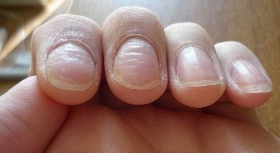 Диагностика по ногтям: как определить заболевание по ногтевой пластине | университетская клиника