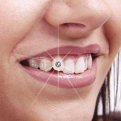 Скайс на зуб (фото): что это такое - процесс установки искусственного бриллианта | spacream.ru