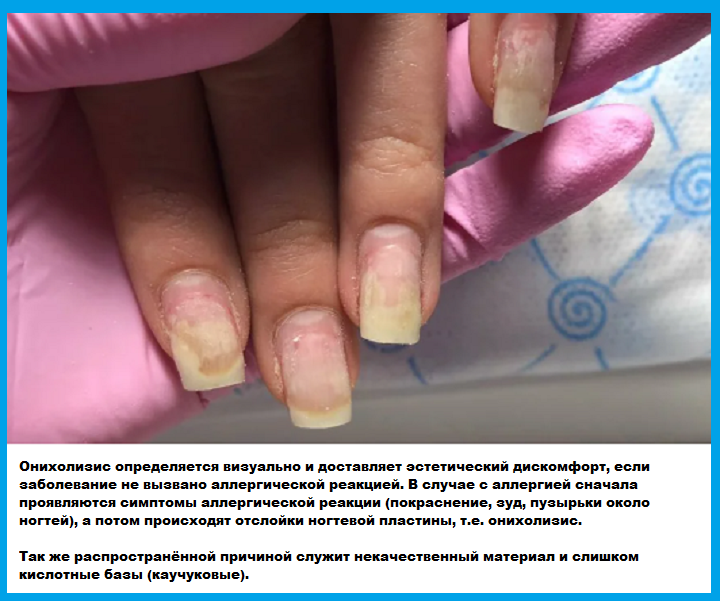 Почему ломаются и слоятся ногти: причины и лечение. что делать, если слоятся ногти на руках и ногах в домашних условиях - medside.ru