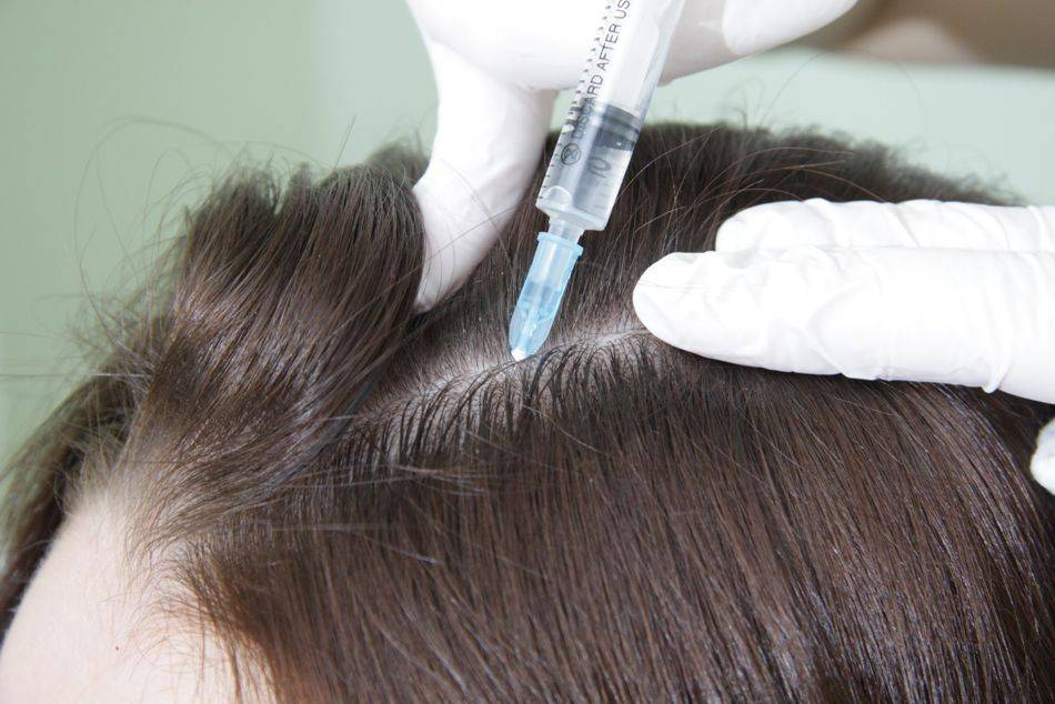 Мезотерапия для роста и восстановления волос. стоит ли делать мезотерапию кожи головы