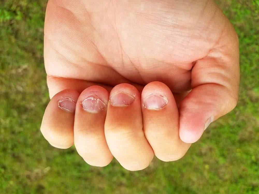 Как отучиться грызть ногти на руках взрослому человеку?